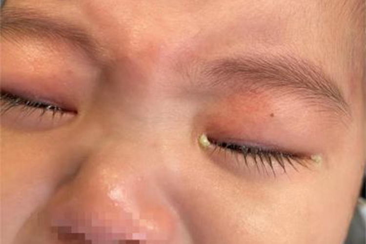 新生儿结膜炎眼部症状图