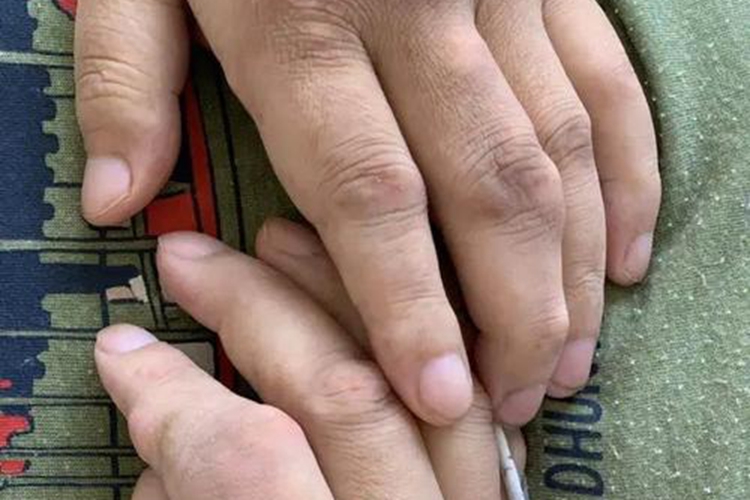 手部初期痛风石图