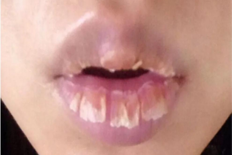 浆细胞性唇炎嘴唇有白色脱皮图 浆细胞性唇炎嘴唇有白色脱皮图