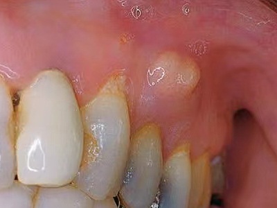 慢性根尖周炎牙龈出现白色小包图.jpeg