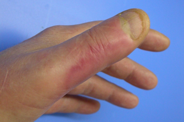 局限型类丹毒手指发红肿胀图