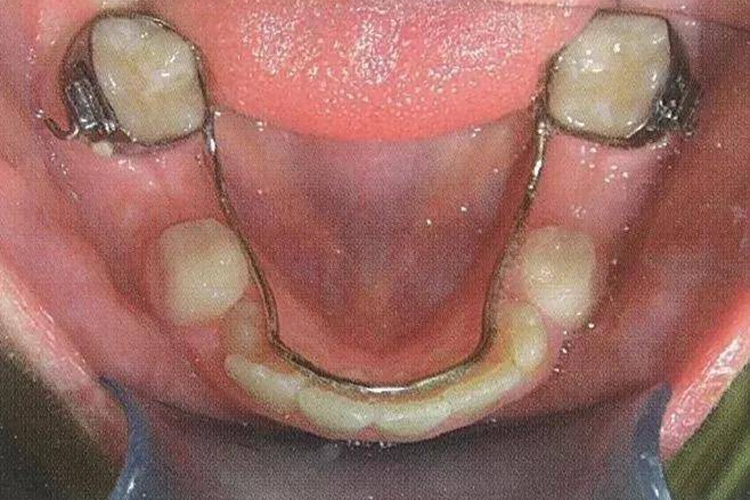 舌弓式间隙保持器图