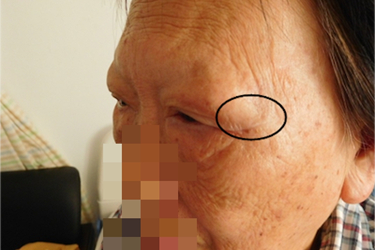 泪囊肿瘤眼角肿块图