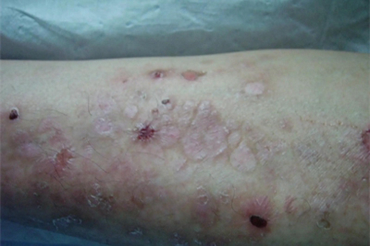 单纯型大疱性表皮松解症小腿斑图 单纯型大疱性表皮松解症小腿斑图