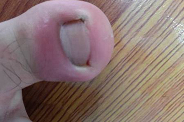 甲床炎脚趾红肿图