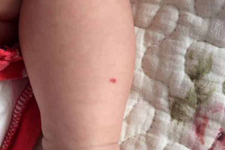 小儿血管瘤小腿有红点图