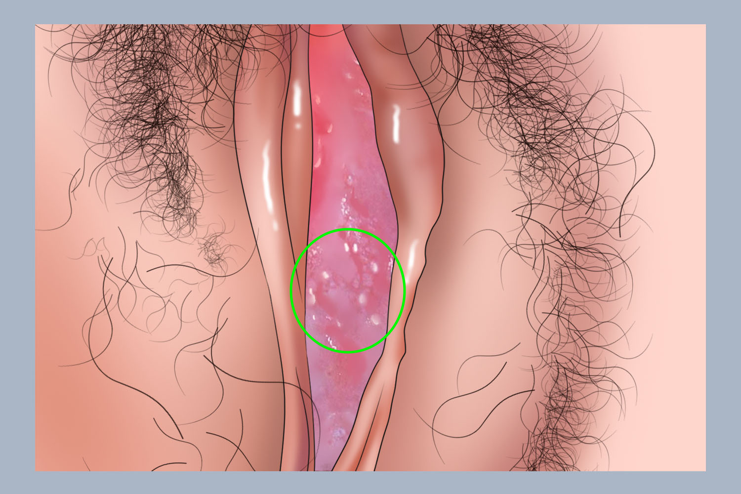慢性外阴溃疡会阴部小疙瘩手绘图