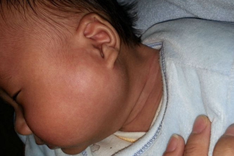 流行性腮腺炎面部症状图