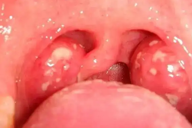 扁桃体隐窝囊肿图