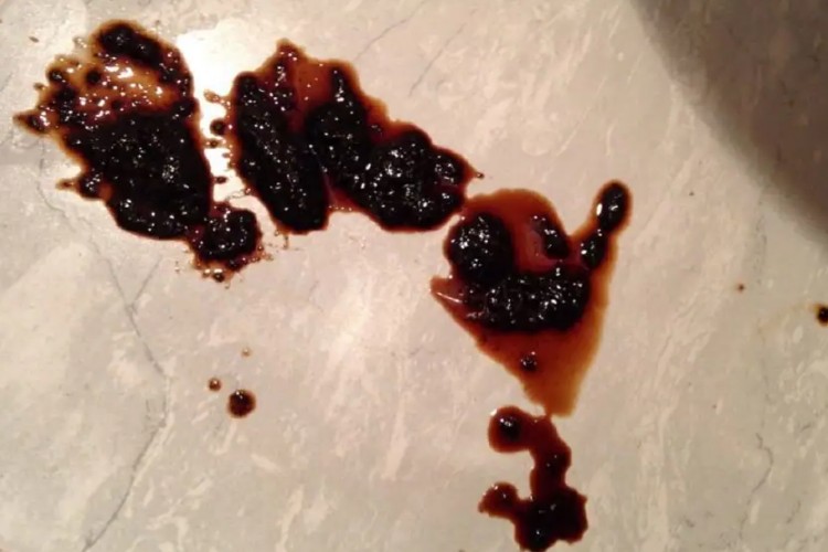 副溶血性弧菌食物中毒血便图