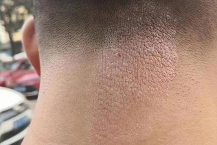 苔藓样皮炎皮纹突出图