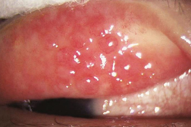 眼结膜炎乳头状增生图 眼结膜炎乳头状增生图