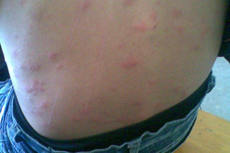 成人痒疹背部疙瘩图 成人痒疹背部疙瘩图