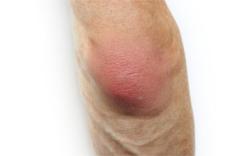 尺骨鹰嘴滑囊炎红肿图