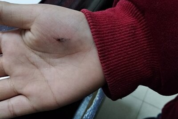 戳伤手掌结痂图 戳伤手掌结痂图