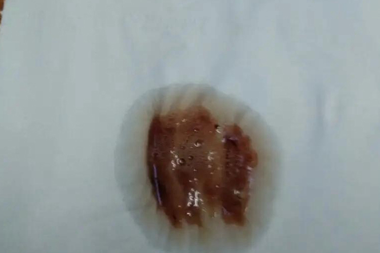 支气管扩张症痰液带血图