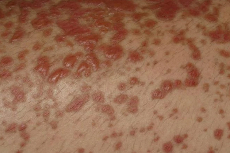 中毒性表皮坏死皮肤水疱图 中毒性表皮坏死皮肤水疱图