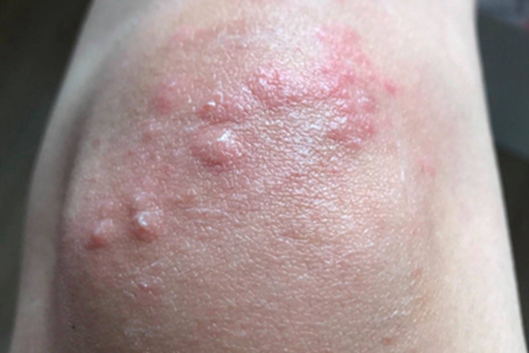 虱病膝盖丘疹图