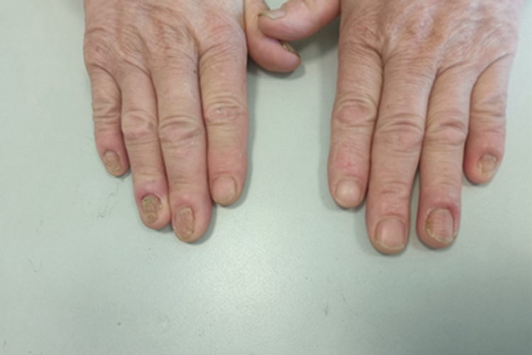 念珠菌性甲真菌病指甲萎缩变黄图