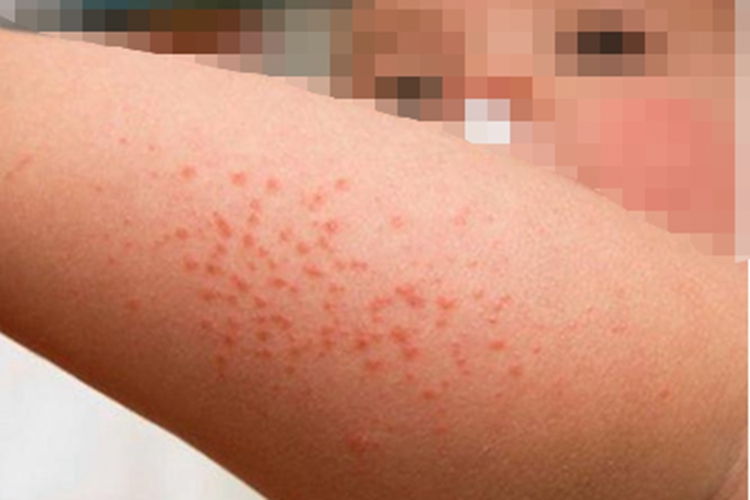 光线性痒疹胳膊丘疹图