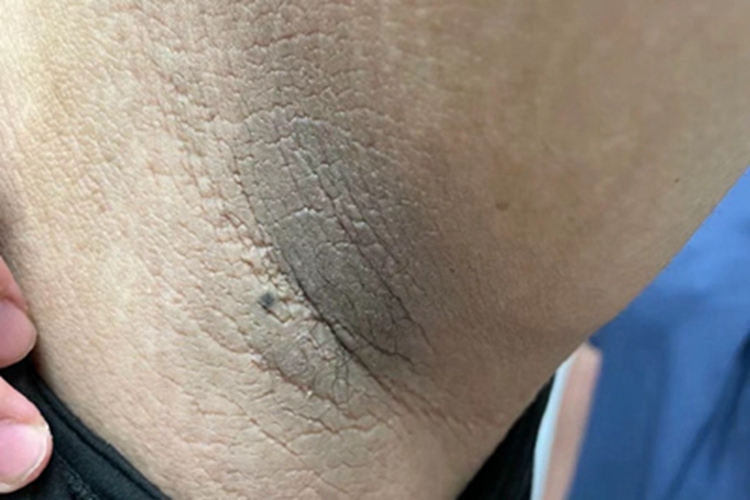 多囊卵巢综合征腋窝色素沉着图