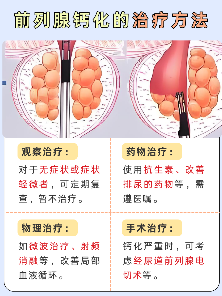 前列腺钙化之谜：这些‘元凶’你知道吗？