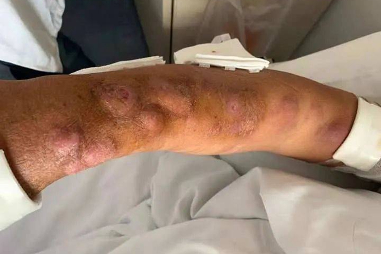 无绿藻病胳膊症状图 无绿藻病胳膊症状图