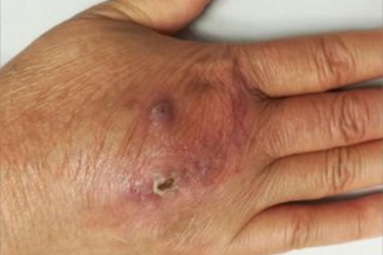 无绿藻病手部症状图