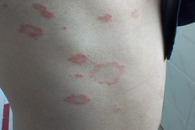 远心性环状红斑肋部红斑图