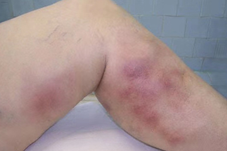 血栓性浅静脉炎腿红斑图 血栓性浅静脉炎腿红斑图