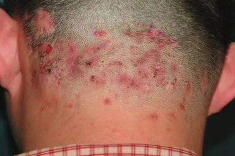 马拉色菌毛囊炎头皮疙瘩图 马拉色菌毛囊炎头皮疙瘩图