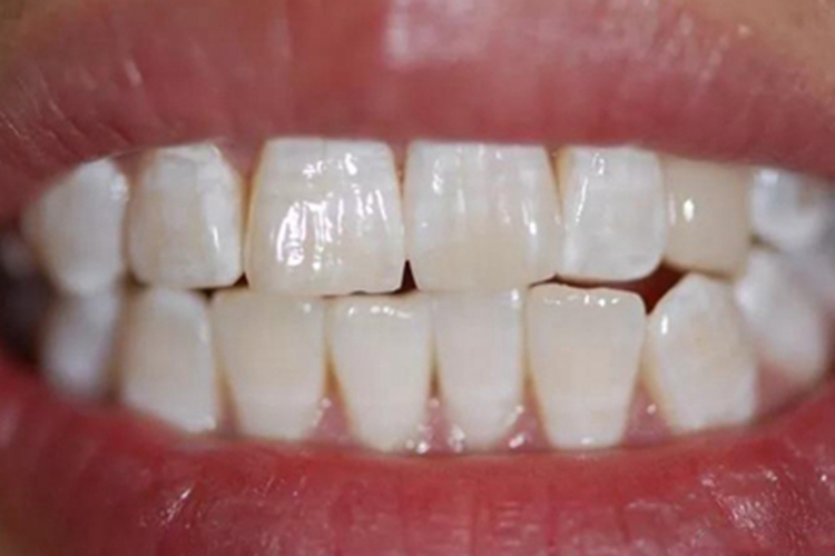 牙釉质发育不全牙齿白斑图