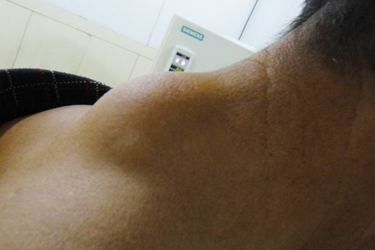 颈部脂肪瘤初起症状图