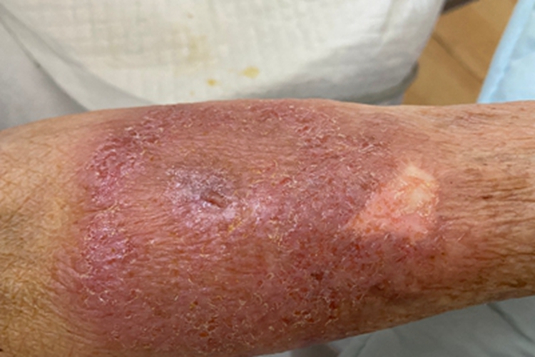 慢性接触性皮炎胳膊脱皮图 慢性接触性皮炎胳膊脱皮图