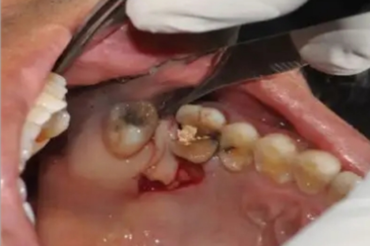 急性坏死性龈口炎牙龈出血图