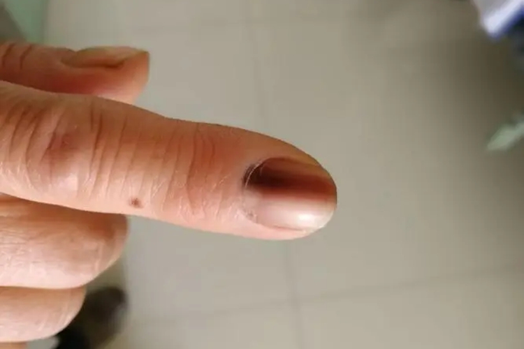 指甲淤血为恶性黑色素瘤图