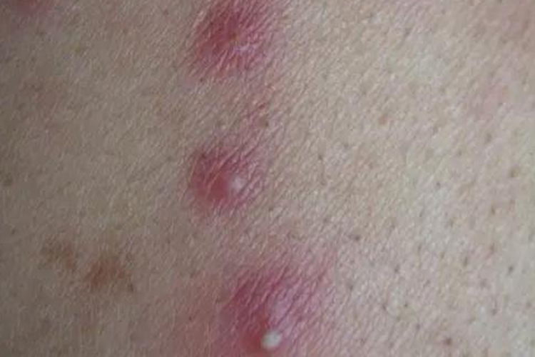 糖尿病毛囊炎图