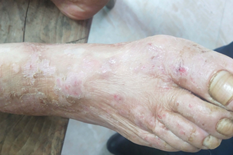 慢性湿疹脚部皮肤溃烂脱皮图 慢性湿疹脚部皮肤溃烂脱皮图