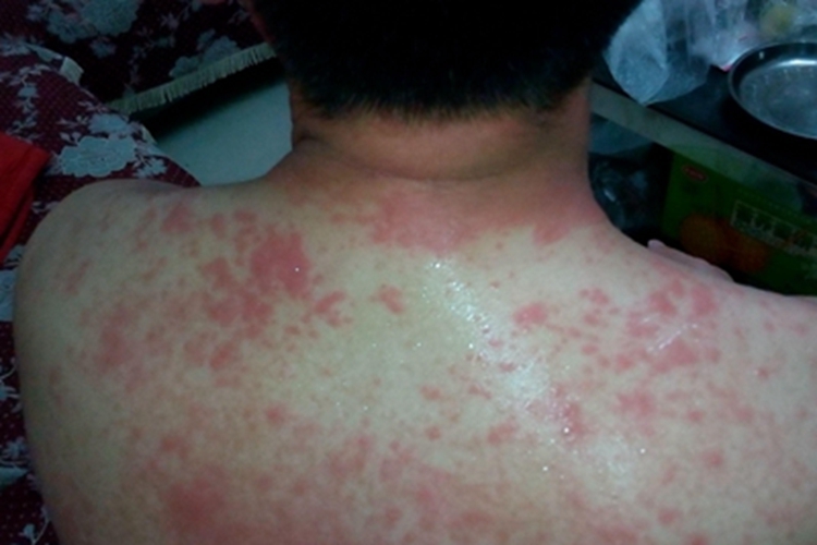 桑毛虫皮炎背部疙瘩图 桑毛虫皮炎背部疙瘩图