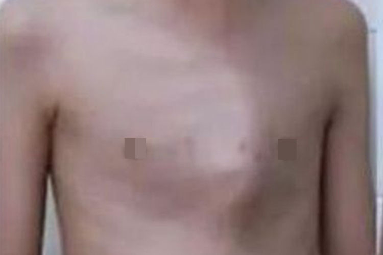 鸡胸胸骨左边鼓起来图