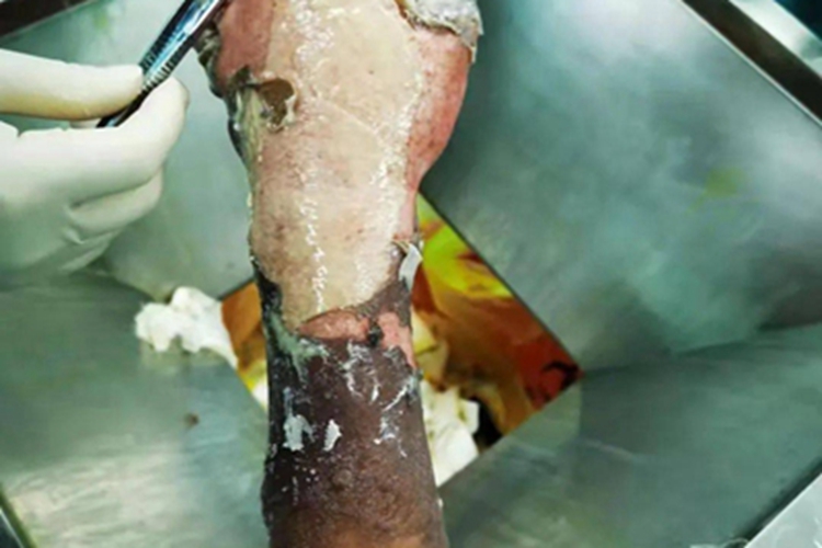 Ⅲ度烧伤手腕发白图