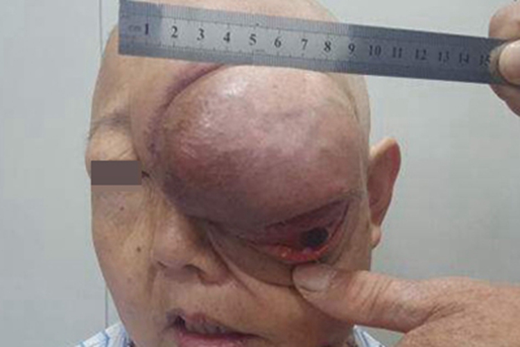 眼眶肿瘤眼周肿块图