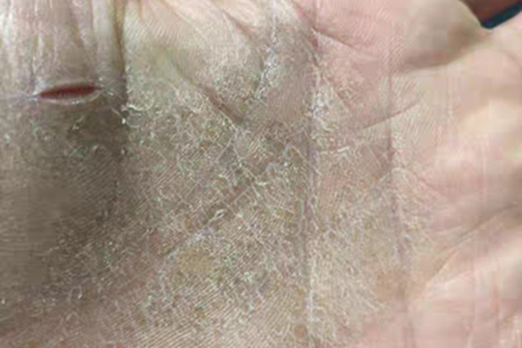 鳞屑角化型手癣手掌裂口图