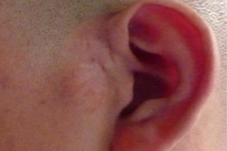 腮腺皮样囊肿症状图 腮腺皮样囊肿症状图