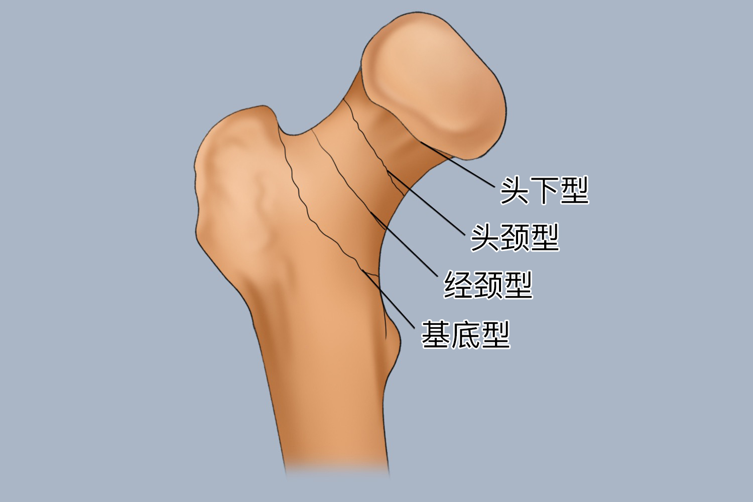 股骨颈骨折骨折线分型