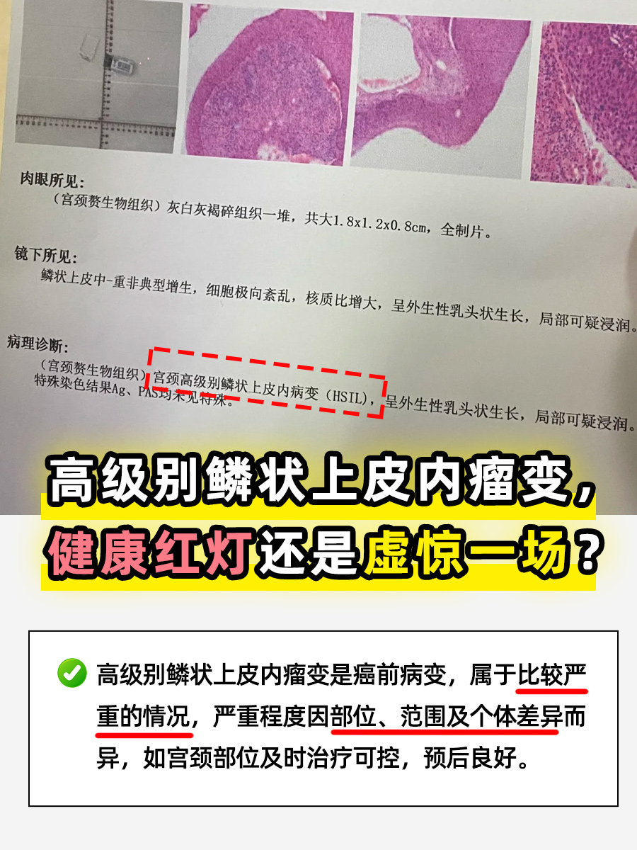 高级别鳞状上皮内瘤变，健康红灯还是虚惊一场？