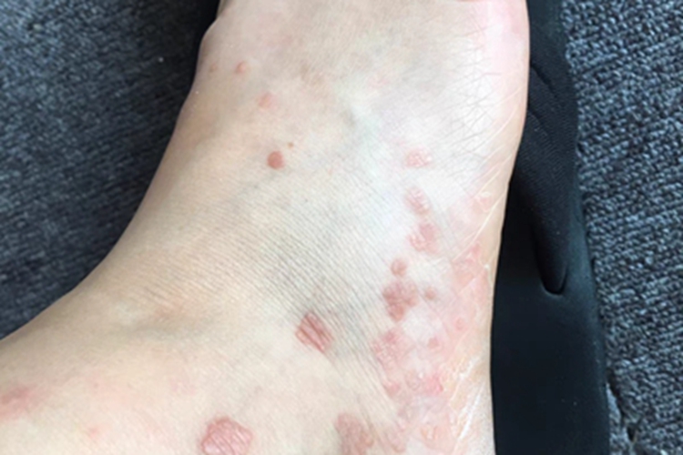 扁平疣脚部疙瘩图