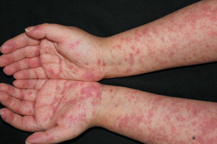 急性移植物抗宿主病红点图