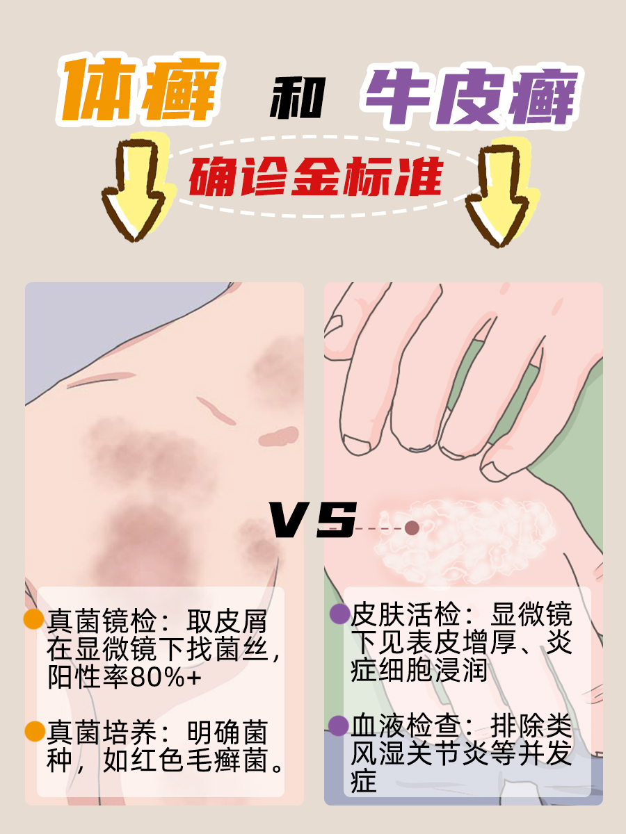 体癣和牛皮癣怎么鉴别?帮你一眼看穿!