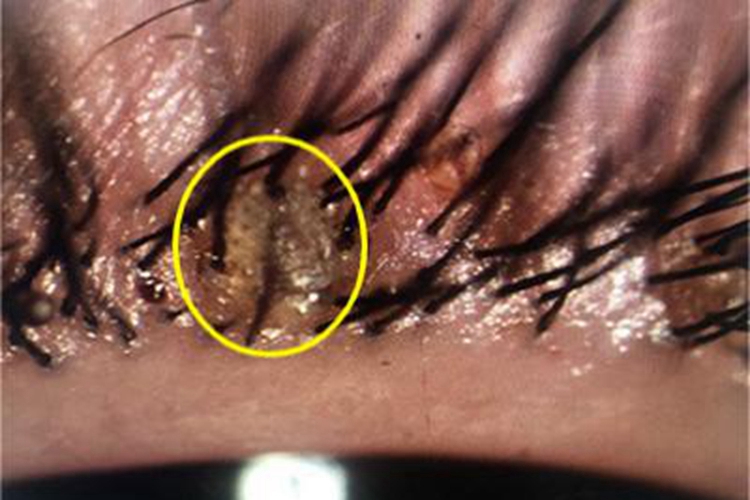 阴虱病眼睑虱虫图